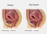 Цистоцеле: причины возникновения, характерные признаки, диагностика и  тактика лечения